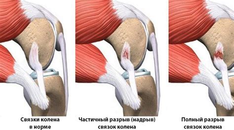 Боль внутренней боковой связки коленного сустава